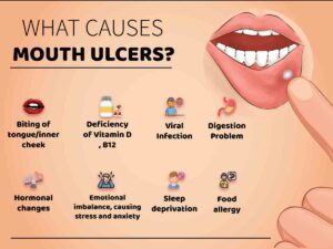 Causes of Mouth Ulcer